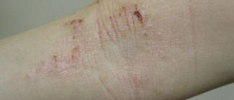 eczema on arm