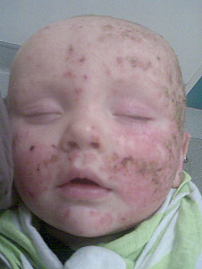 Toby's eczema homeopathy with dairy intolerance baby eczema picture
