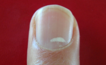 zinc-spot-fingernail