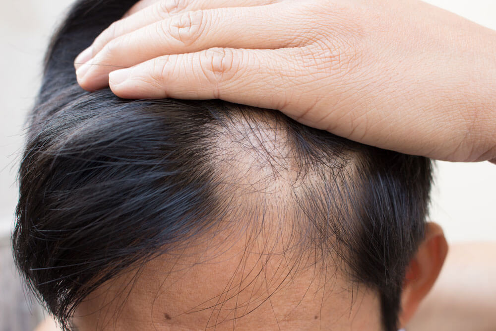 Hair loss and Homeopathic support
