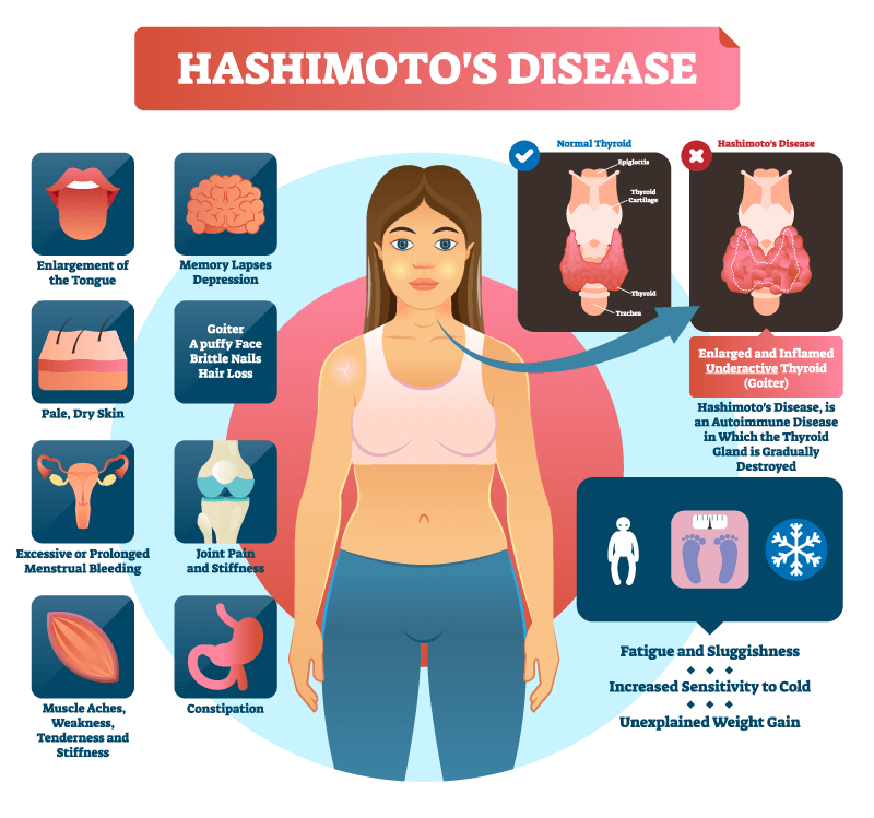 Hashimoto Symptoms diagram