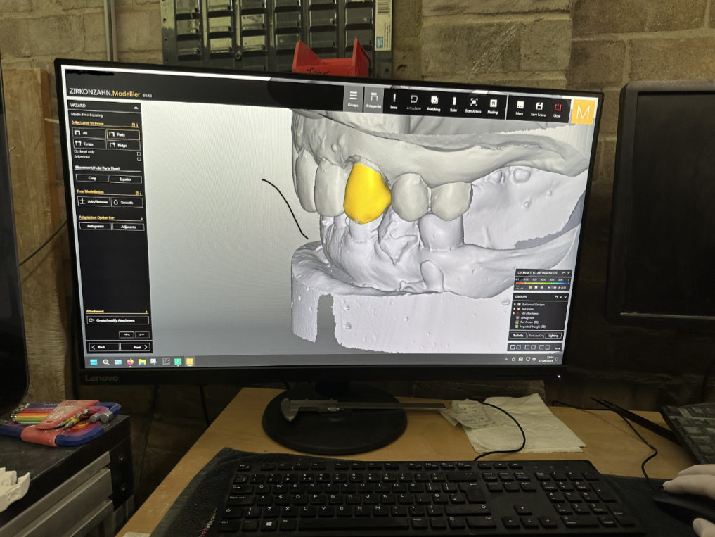 CAD image of tooth