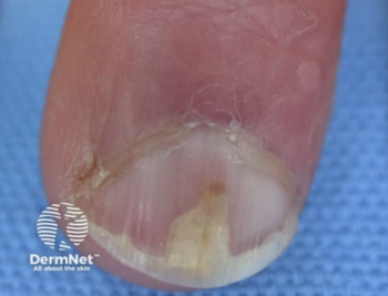 onycholysis source of the image is dermetnz.org