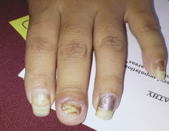 Individualized Homeopathy in the Treatment of Subungual Onychomycosis: An Evidence-based Case Report